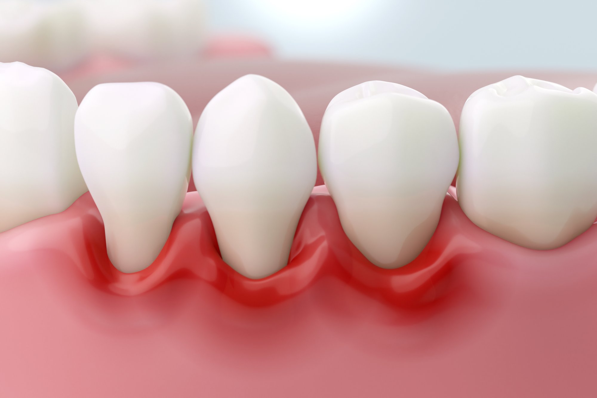 How Do Dentists Treat Gum Disease Without Surgery?